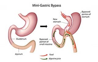 Gastric-Bypass-Crown-Valley-Surgical-Center