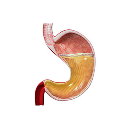Stomach-Endoscopy-Crown-Valley-Surgical-Center