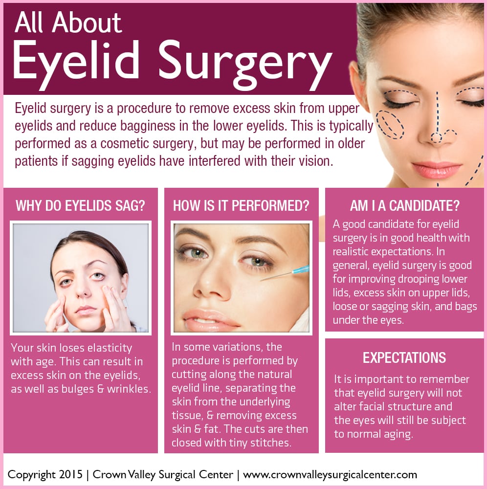 All-About-Eyelid-Surgery-by-Crown-Valley-Surgical-Center
