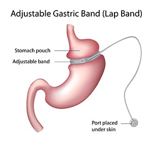 Lap-Band-Revision-Crown-Valley-Surgical-Center