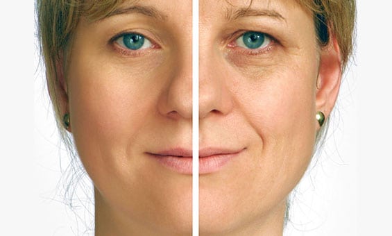 Facelift-Orange-County-1-Crown-Valley-Surgical-Center