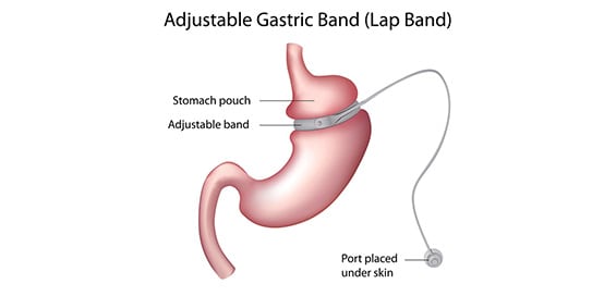 Lap-Band-Revision-1-Crown-Valley-Surgical-Center
