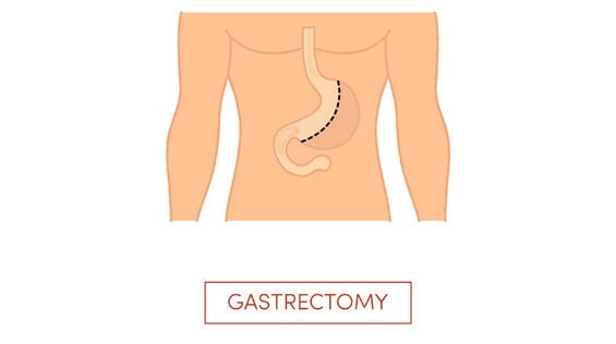 Sleeve-Gastrectomy-1-Crown-Valley-Surgical-Center