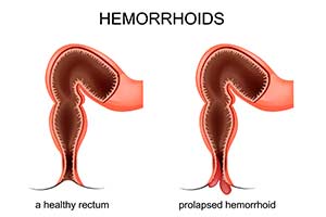 Hemorrhoid Specialist