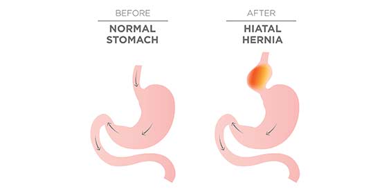 Hiatal-Hernia-Surgery-Crown-Valley-Surgical-Center