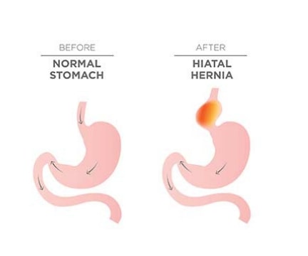 hiatal-hernia