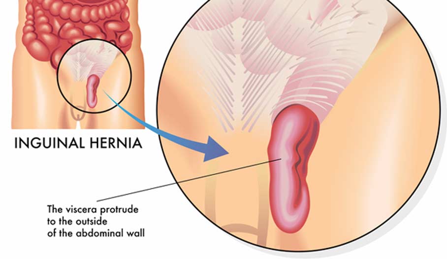 illustration-of-inguinal-hernia-Crown-Valley-Surgical-Center