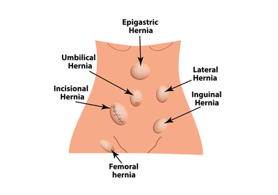 location-of-inguinal-hernia-Crown-Valley-Surgical-Center